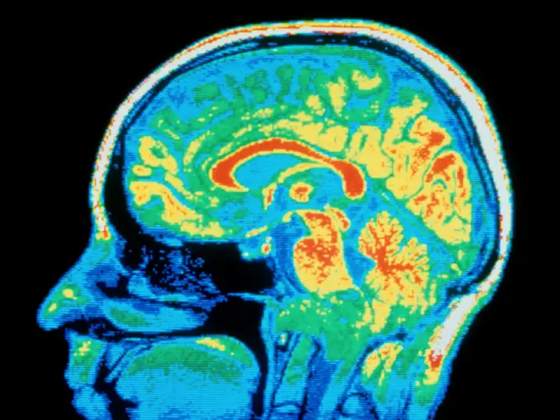 A brain scan image